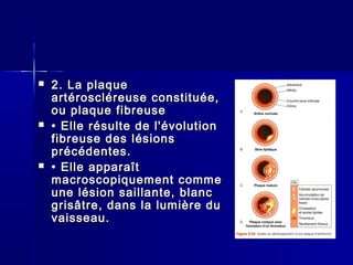  22.. LLaa ppllaaqquuee 
aarrttéérroosscclléérreeuussee ccoonnssttiittuuééee,, 
oouu ppllaaqquuee ffiibbrreeuussee 
 •• EEllllee rrééssuullttee ddee ll''éévvoolluuttiioonn 
ffiibbrreeuussee ddeess llééssiioonnss 
pprrééccééddeenntteess.. 
 •• EEllllee aappppaarraaîîtt 
mmaaccrroossccooppiiqquueemmeenntt ccoommmmee 
uunnee llééssiioonn ssaaiillllaannttee,, bbllaanncc 
ggrriissââttrree,, ddaannss llaa lluummiièèrree dduu 
vvaaiisssseeaauu.. 
 