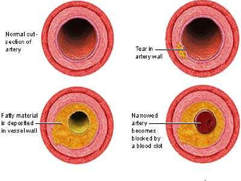 Atherosclerosis