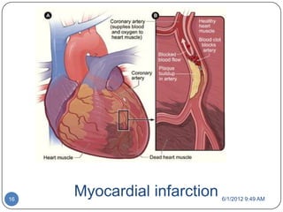 16
     Myocardial infarction   6/1/2012 9:49 AM
 