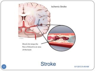 17
     Stroke   6/1/2012 9:49 AM
 