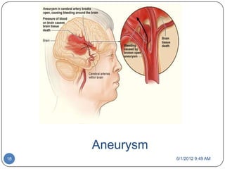 Aneurysm
18              6/1/2012 9:49 AM
 