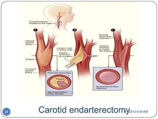 24   Carotid endarterectomy
                         6/1/2012 9:49 AM
 
