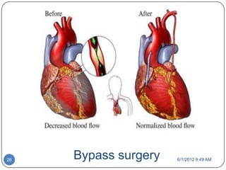 26   Bypass surgery   6/1/2012 9:49 AM
 
