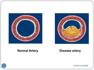 Normal Artery   Disease artery



3                            6/1/2012 9:49 AM
 