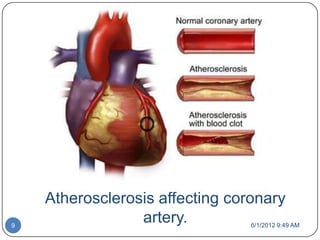 Atherosclerosis affecting coronary
9
                 artery.         6/1/2012 9:49 AM
 