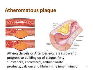 Atheromatous plaque




  Atherosclerosis or Arteriosclerosis is a slow and
  progressive building up of plaque, fatty
  substances, cholesterol, cellular waste
  products, calcium andBiochemistry forin the inner lining of
11/15/2012               fibrin Medics                          10
 