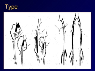 Type 