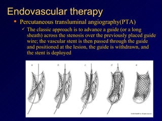 Endovascular therapy Percutaneous transluminal angiography(PTA)  The classic approach is to advance a guide (or a long sheath) across the stenosis over the previously placed guide wire; the vascular stent is then passed through the guide and positioned at the lesion, the guide is withdrawn, and the stent is deployed  