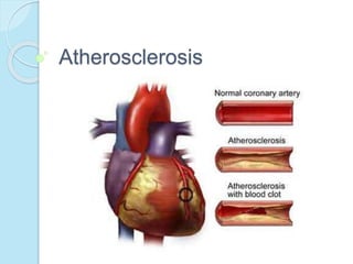 Atherosclerosis
 