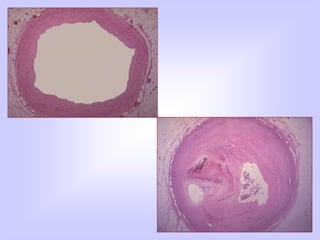 Atherosclerosis pathology mbbs