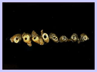 Atherosclerosis pathology mbbs
