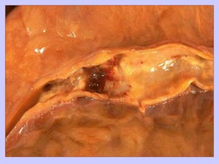 Atherosclerosis pathology mbbs