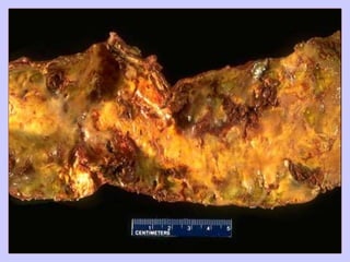 Atherosclerosis pathology mbbs