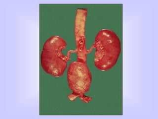 Atherosclerosis pathology mbbs