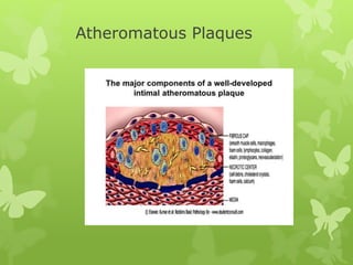 Atheromatous Plaques
 