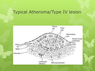 Typical Atheroma/Type IV lesion
 