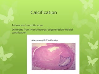 Calcification
Intima and necrotic area
Different from Monckebergs degeneration-Medial
calcification
 