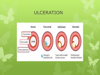 ULCERATION
 