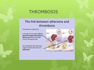 THROMBOSIS
 