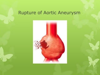 Rupture of Aortic Aneurysm
 
