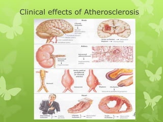 Clinical effects of Atherosclerosis
 