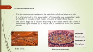 2- Fibrous Atheromatous
• The fibrous atheromatous plaque is the basic lesion of clinical atherosclerosis.
• It is characterized by the accumulation of intracellular and extracellular lipids,
proliferation of vascular smooth muscle cells, and formation of scar tissue.
• The lesions begin as a elevated thickening of the vessel intima with a core of
extracellular lipid covered by a fibrous cap of connective tissue and smooth
muscle.
7/27/2019
10
Fatty streak Fibrous Atheromatous
 