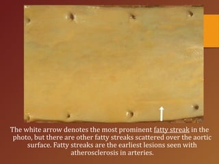 The white arrow denotes the most prominent fatty streak in the
photo, but there are other fatty streaks scattered over the aortic
surface. Fatty streaks are the earliest lesions seen with
atherosclerosis in arteries.
 