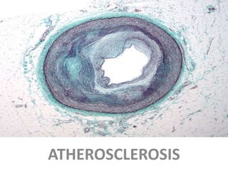 ATHEROSCLEROSIS
 