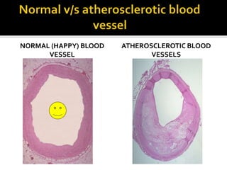 NORMAL (HAPPY) BLOOD
VESSEL
ATHEROSCLEROTIC BLOOD
VESSELS
 
