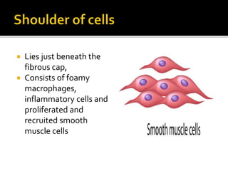  Lies just beneath the
fibrous cap,
 Consists of foamy
macrophages,
inflammatory cells and
proliferated and
recruited smooth
muscle cells
 