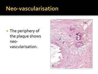 The periphery of
the plaque shows
neo-
vascularisation.
 