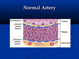 Normal Artery
 