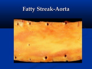 Fatty Streak-Aorta
 