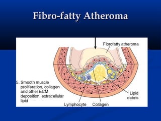 Fibro-fatty Atheroma
 