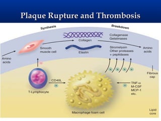 Plaque Rupture and Thrombosis
 