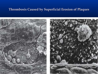 Thrombosis Caused by Superficial Erosion of Plaques
 