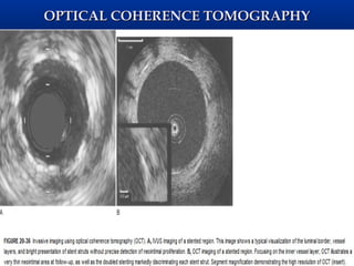 OPTICAL COHERENCE TOMOGRAPHY
 