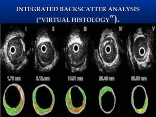 INTEGRATED BACKSCATTER ANALYSIS
     (“VIRTUAL HISTOLOGY”).
 