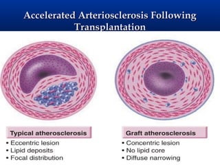 Accelerated Arteriosclerosis Following
           Transplantation
 
