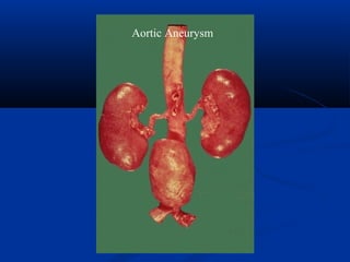 Aortic Aneurysm
 