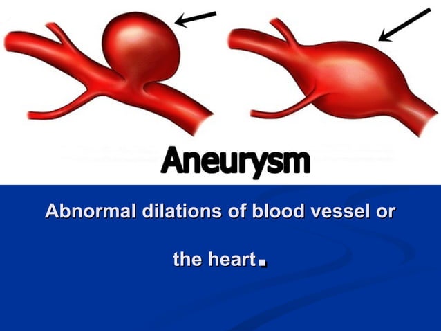 Atherosclerosis and aneurysm | PPT | Heart and Cardiovascular Diseases ...