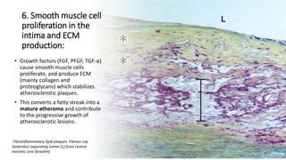 6. Smooth muscle cell
proliferation in the
intima and ECM
production:
• Growth factors (FGF, PFGF, TGF-α)
cause smooth muscle cells
proliferate, and produce ECM
(mainly collagen and
proteoglycans) which stabilizes
atherosclerotic plaques.
• This converts a fatty streak into a
mature atheroma and contribute
to the progressive growth of
atherosclerotic lesions.
Fibroinflammatory lipid plaques. Fibrous cap
(asterisks) separating lumen (L) from central
necrotic core (bracket).
 