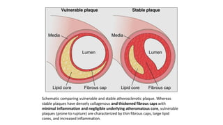Schematic comparing vulnerable and stable atherosclerotic plaque. Whereas
stable plaques have densely collagenous and thickened fibrous caps with
minimal inflammation and negligible underlying atheromatous core, vulnerable
plaques (prone to rupture) are characterized by thin fibrous caps, large lipid
cores, and increased inflammation.
 