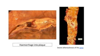Haemorrhage into plaque
Severe atherosclerosis of the aorta
 