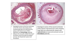• Histological section of the first centimeter
of the left anterior descending artery
showing large lipid-core atherosclerotic
plaque, with internal area of fibrin
deposition and hemorrhage (asterisk).
• Observe the area with marked thinning of
the fibrous cap of the lipid core plaque
(arrow), site of potential rupture and
thrombosis.
Histological section of the second centimeter
of the anterior interventricular artery showing
large lipid-core atherosclerotic plaque with
ruptured area (arrows) and occlusive luminal
thrombosis (asterisk)
 