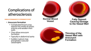 Complications of
atherosclerosis
• Aneurysm formation
• Complicated lesions may
extend into media of elastic
arteries and weaken their
walls
• They allow aneurysm
formation
• Typically in abdominal aorta
• Sudden rupture may
precipitatea vascular
catastrophe
 
