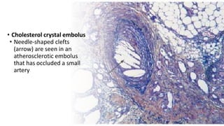 • Cholesterol crystal embolus
• Needle-shaped clefts
(arrow) are seen in an
atherosclerotic embolus
that has occluded a small
artery
 