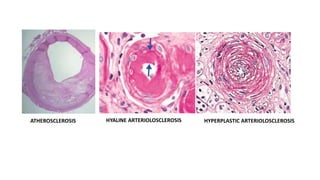 HYALINE ARTERIOLOSCLEROSIS HYPERPLASTIC ARTERIOLOSCLEROSIS
ATHEROSCLEROSIS
 