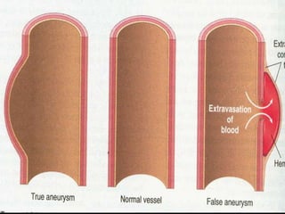 Atherosclerosis &aneurysms | PPTX