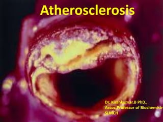 Atherosclerosis
Dr. Kirankumar.B PhD.,
Assoc.Professor of Biochemistry
SLMCH
 